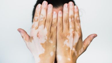 مرض البهاق اسبابه وعلاجه بالأعشاب